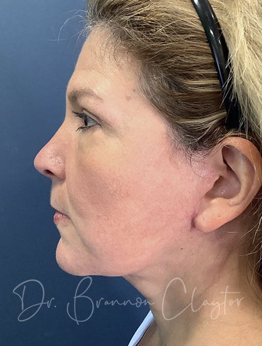 After the facelift, woman's face shows a pronounce oval jawline, good skin elasticity, no double chin or turkey neck, and a natural appearance
