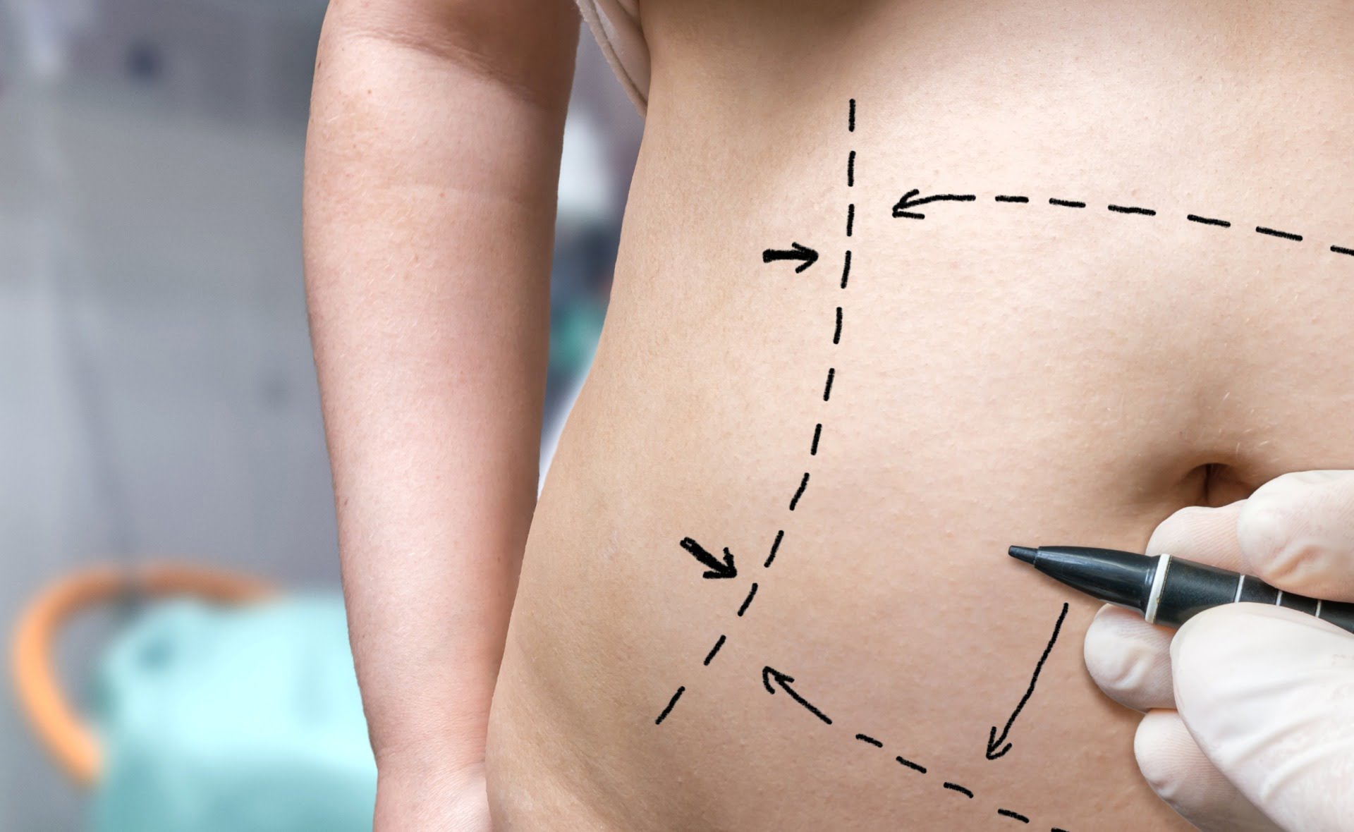 tummy tuck recovery week by week blog tummy tuck recovery week by week blog