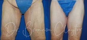 Thigh Lift Surgery Before and After Philadelphia