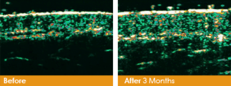 Before and After PrecisionTx | Claytor Noone Plastic Surgery | Bryn Mawr, PA