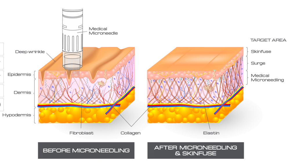 Microneedling | Claytor Noone Plastic Surgery | Bryn Mawr, PA