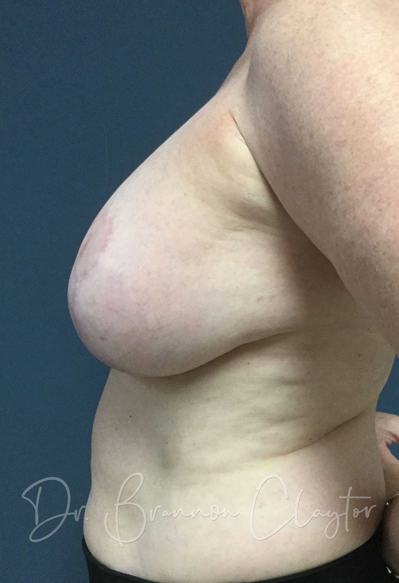 Breast Augmentation with Lift