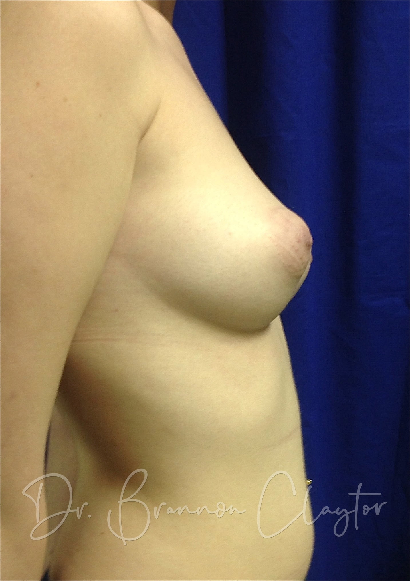 Breast Augmentation 350 cc silicone implant