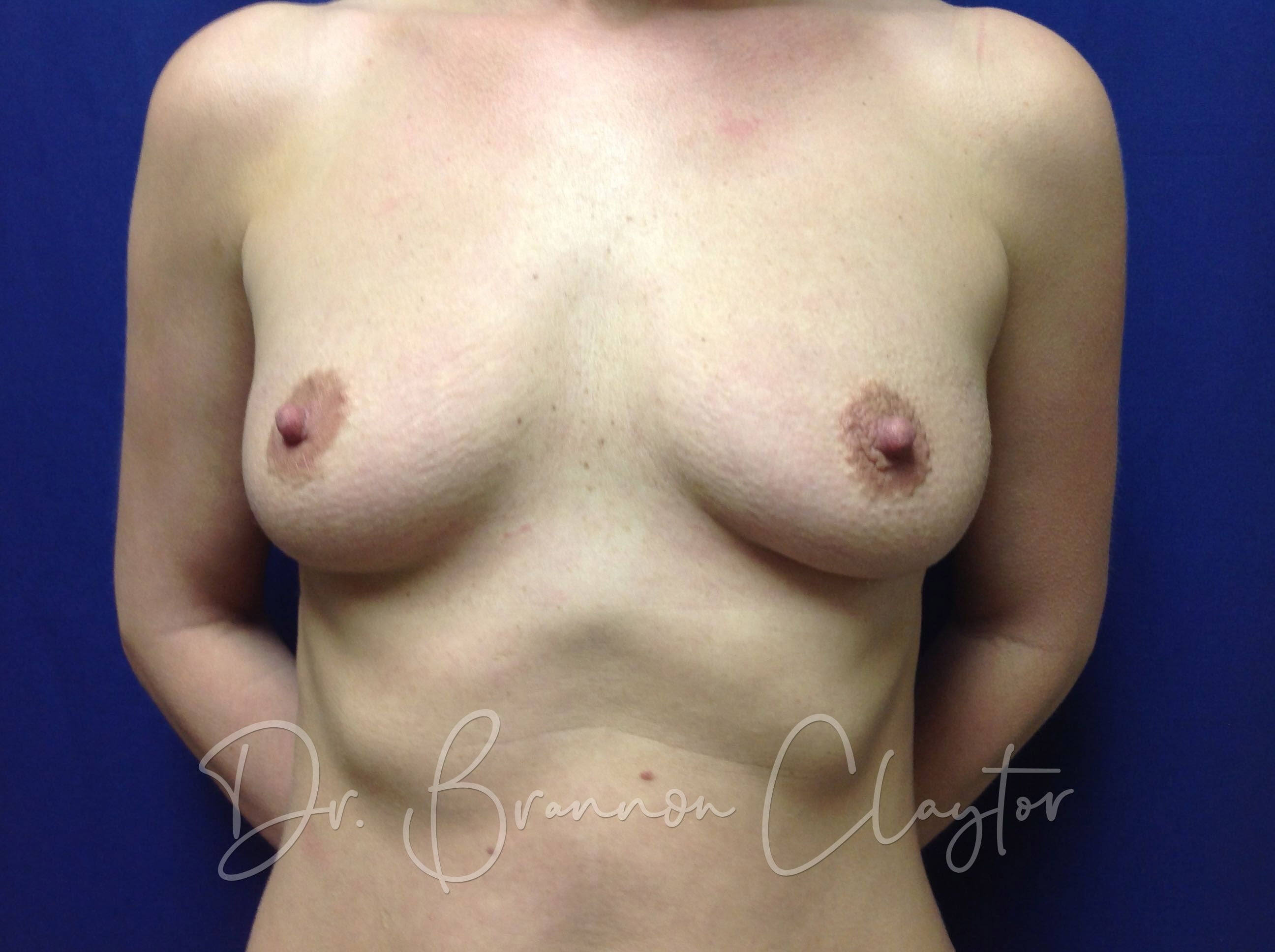 Silicone Breast Augmentation 400cc