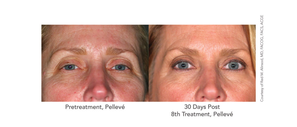 pelleve main line | skin tightening bryn mawr pelleve main line | skin tightening bryn mawr