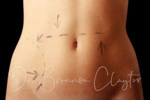 abdominoplasty