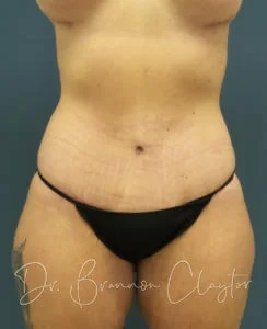 tummy tuck after