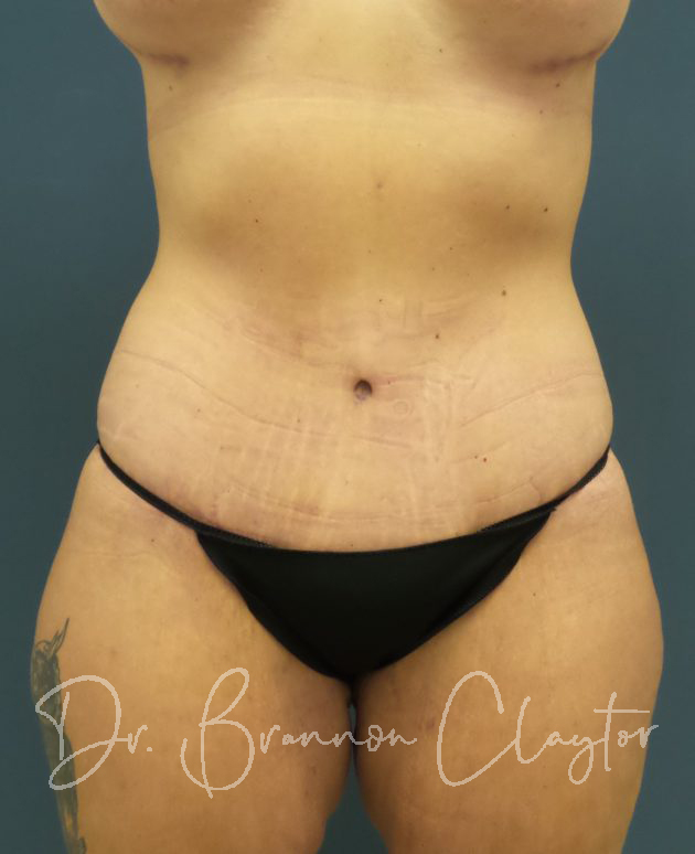 Tummy Tuck (Abdominoplasty) - Philadelphia, PA - Claytor Noone