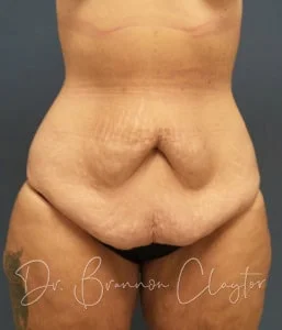 tummy tuck before tummy tuck before