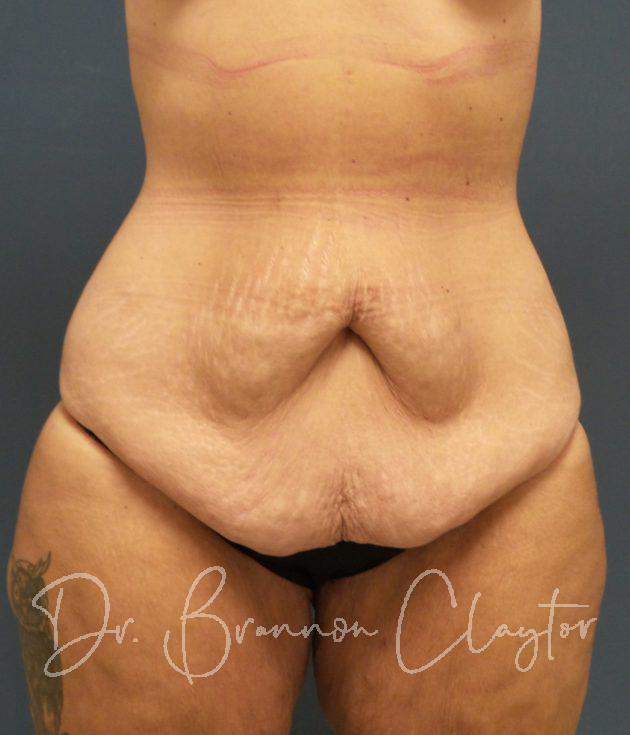 Tummy tuck 100 pre-op