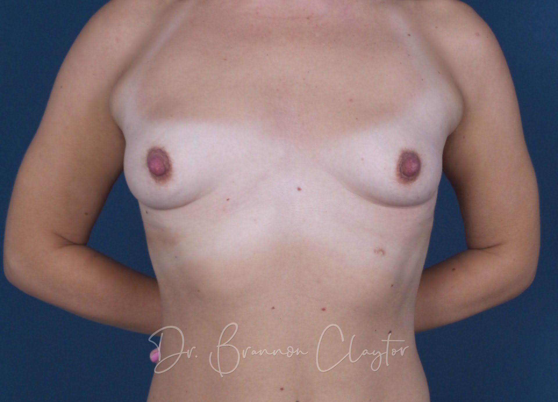 Breast Augmentation with 265 cc Silicone