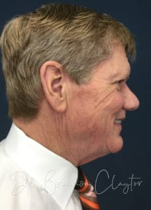 Male Facelift Philadelphia | Bryn Mawr PA Male Facelift Philadelphia | Bryn Mawr PA