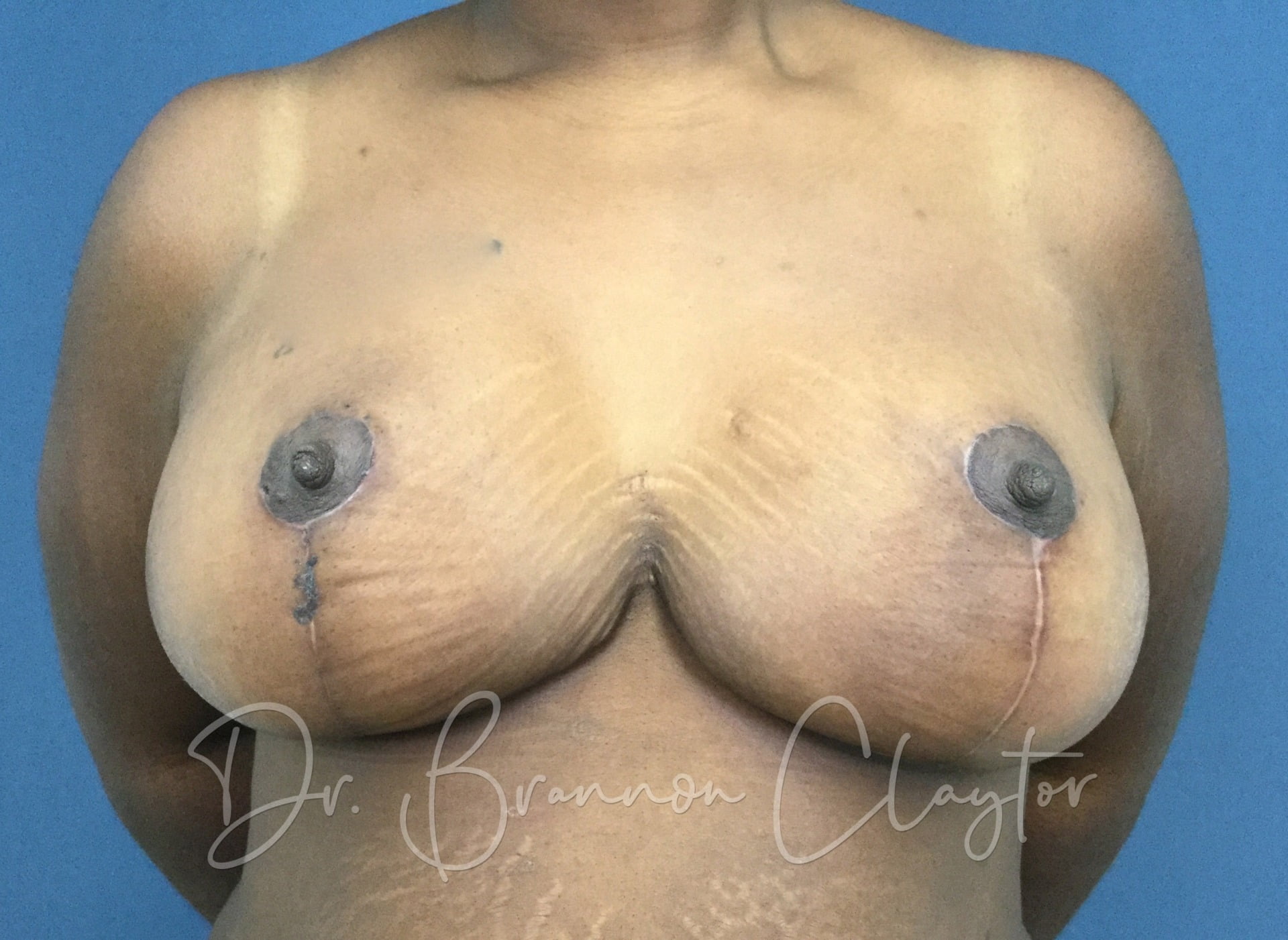 Breast Reduction