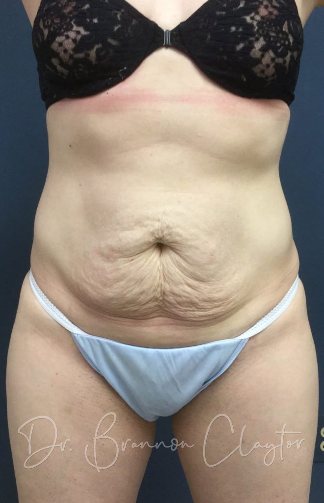 Tummy Tuck Before and After Philadelphia PA