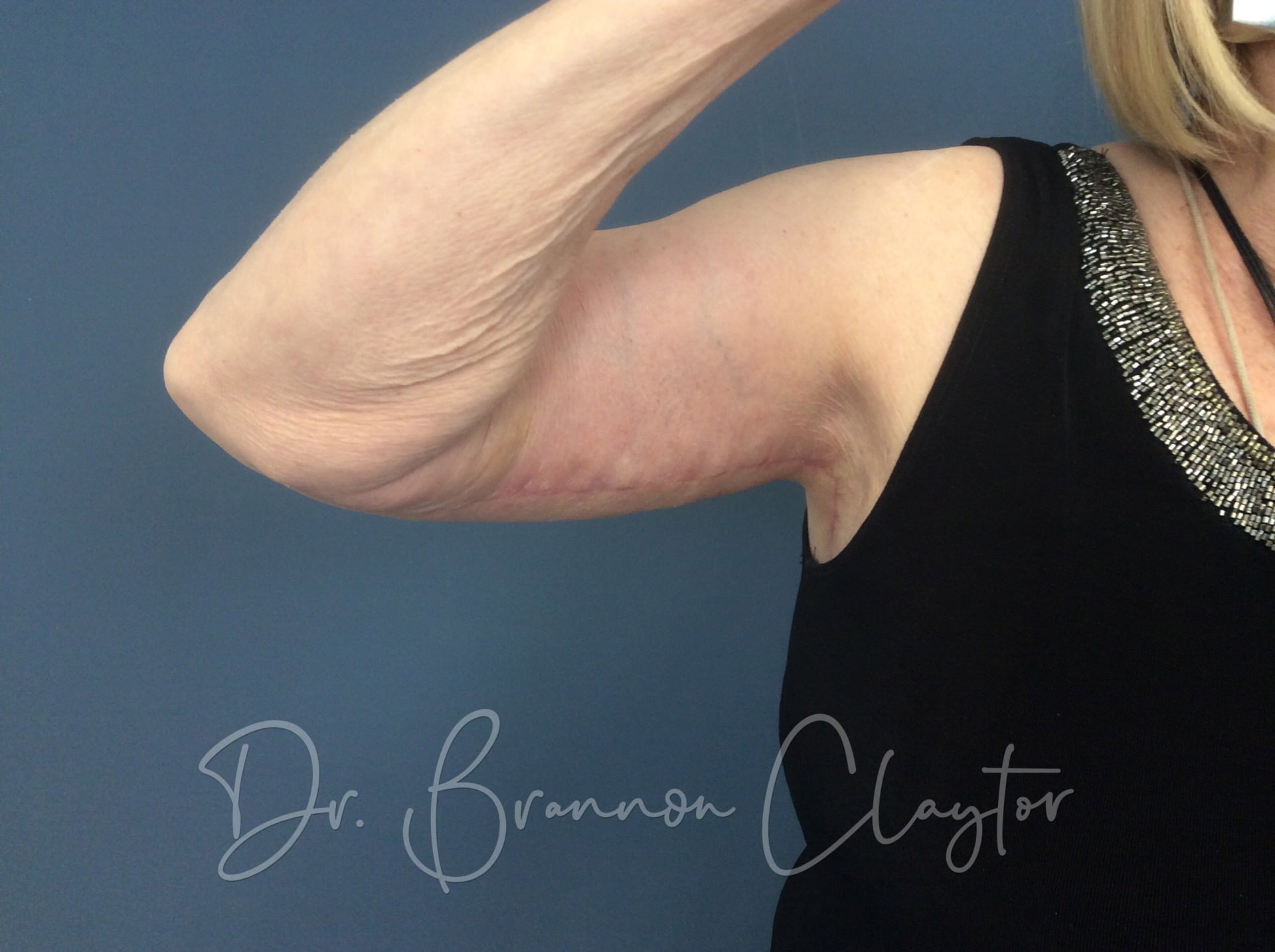 Arm Lift (Brachioplasty)