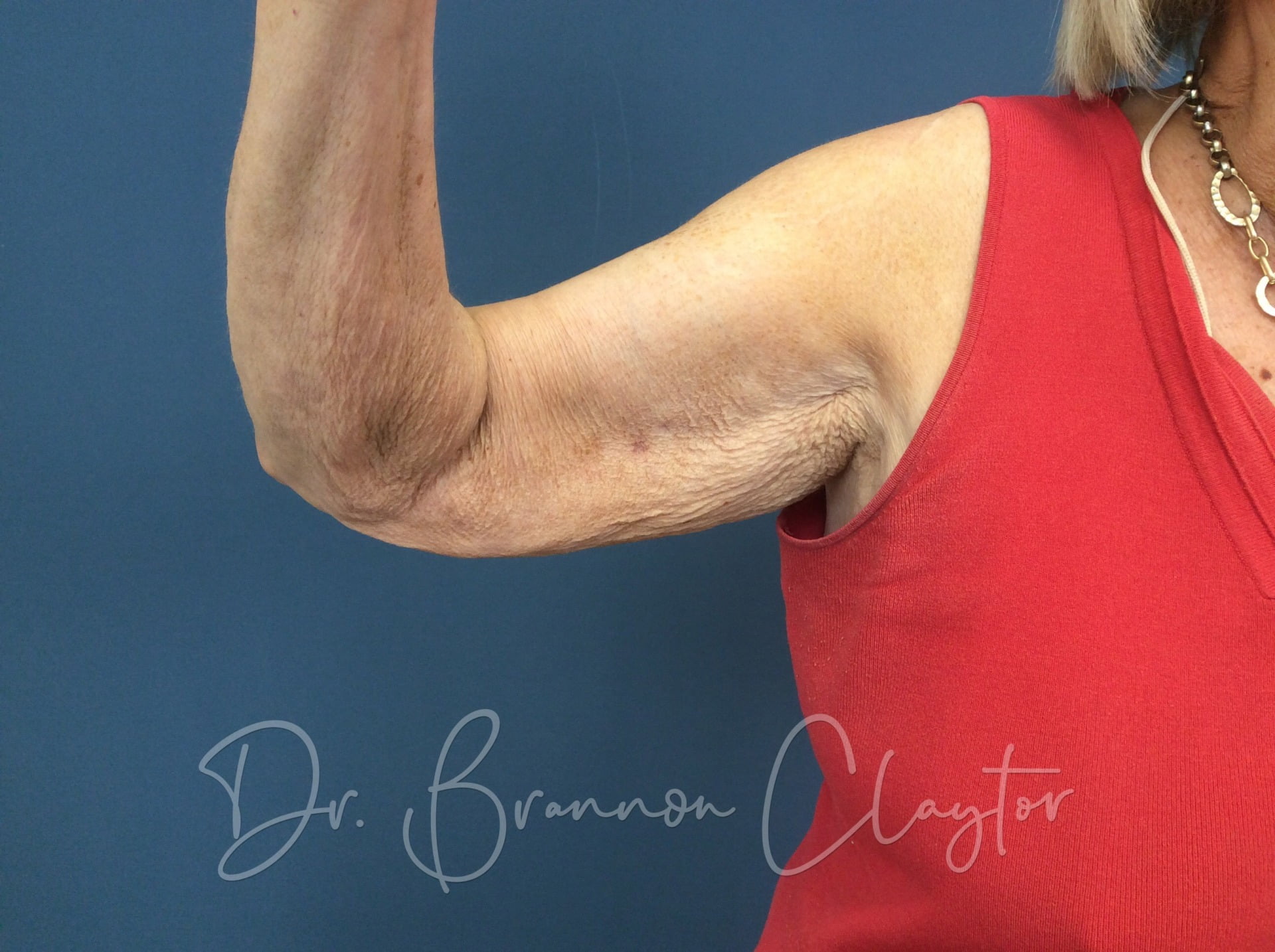 Arm Lift (Brachioplasty)