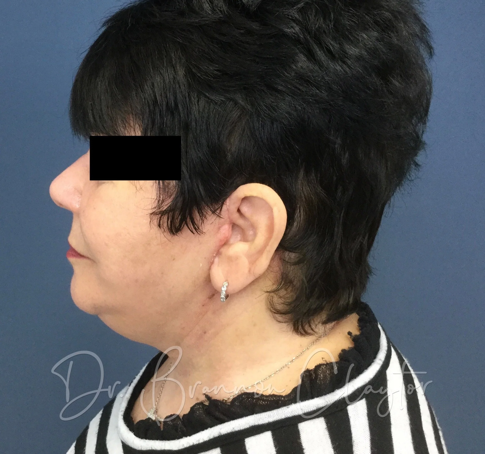 Facelift with Smartlipo