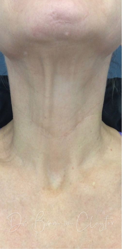 IPL and Fractional Laser "after" photo showing diminished dark spots, glowing skin tone, and smoother skin texture in the neck