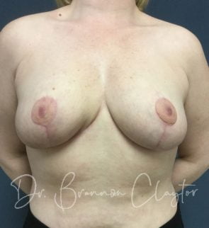 Breast Reduction & Mastopexy