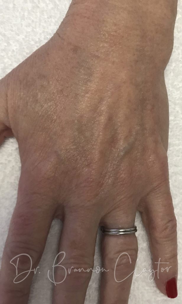 IPL and Fractional Laser Philadelphia PA