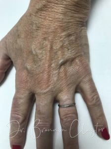 IPL and Fractional Laser Philadelphia PA