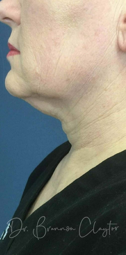 Fractional Laser Before and After Philadelphia