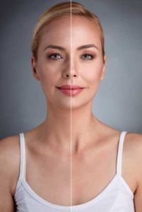 Dermal Fillers | Claytor Noone Plastic Surgery | Bryn Mawr PA