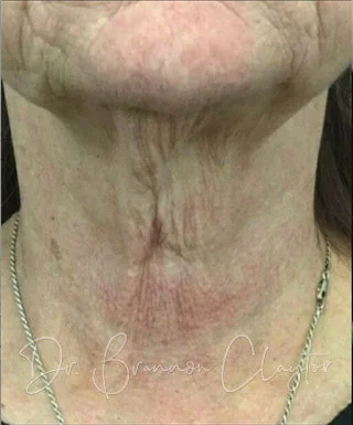Fractional Laser