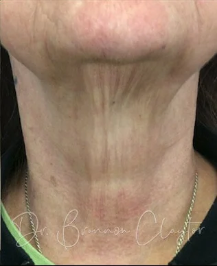 Fractional Laser