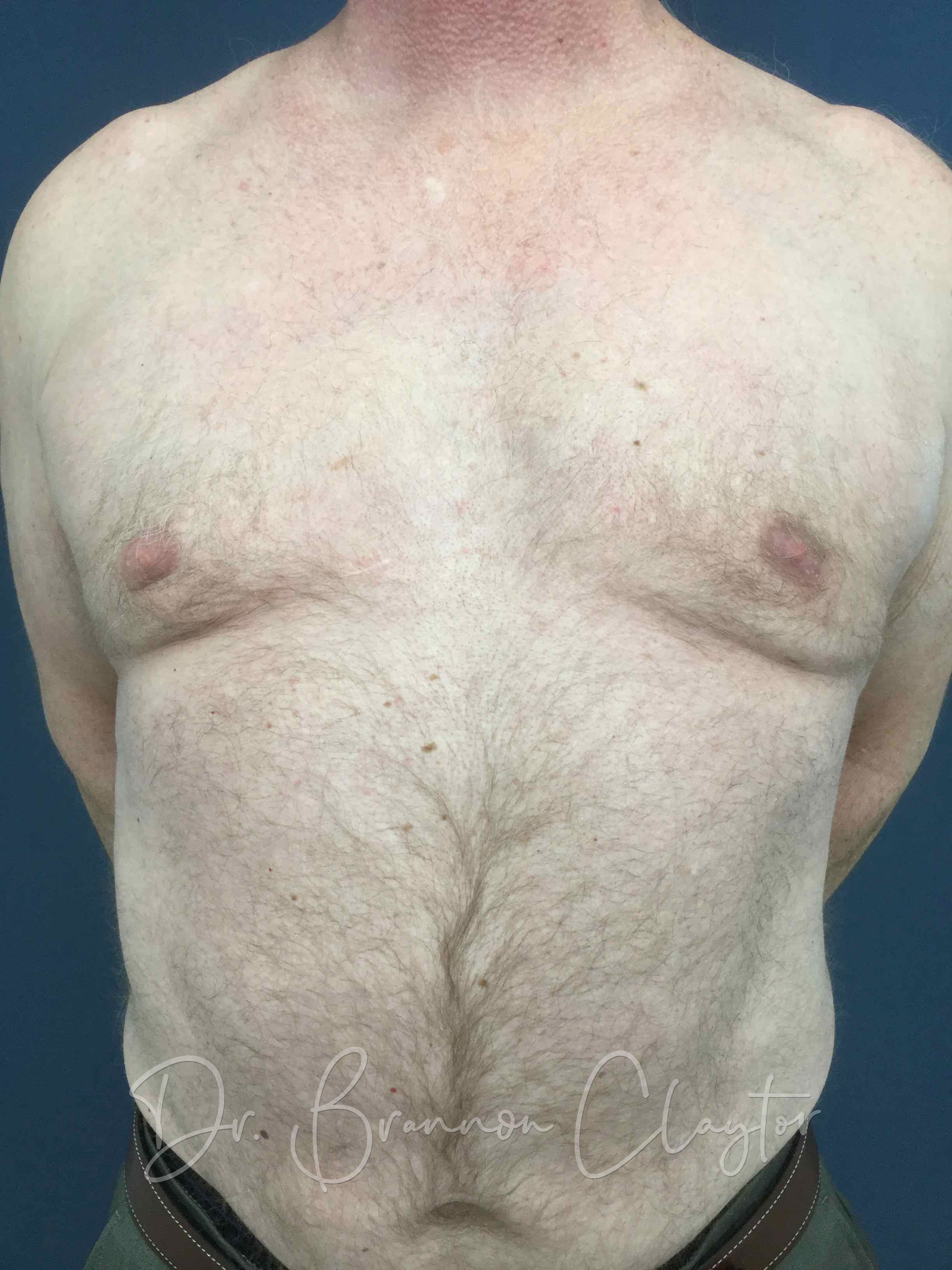 male breast reduction after photo