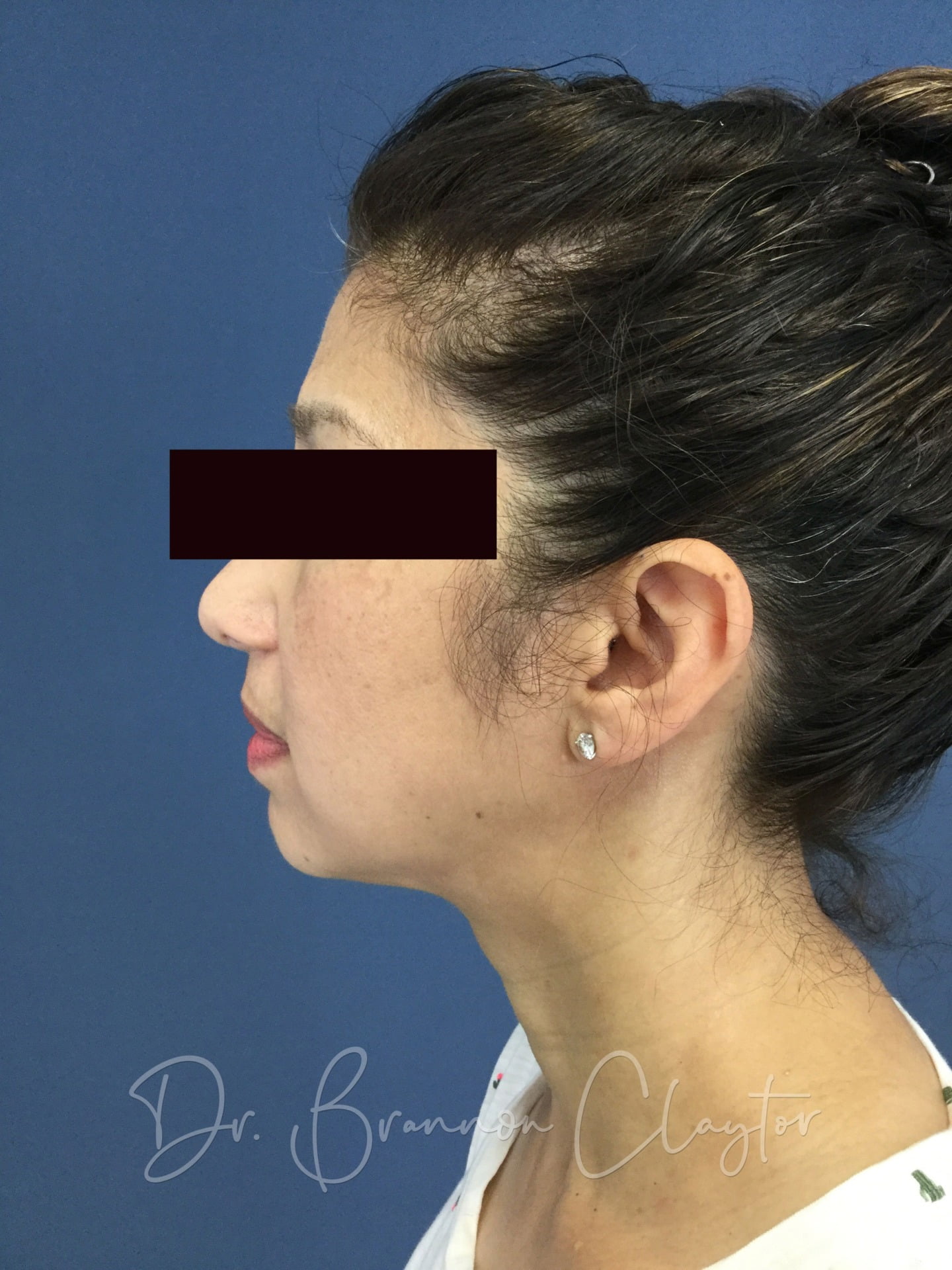 SmartLipo of the Neck