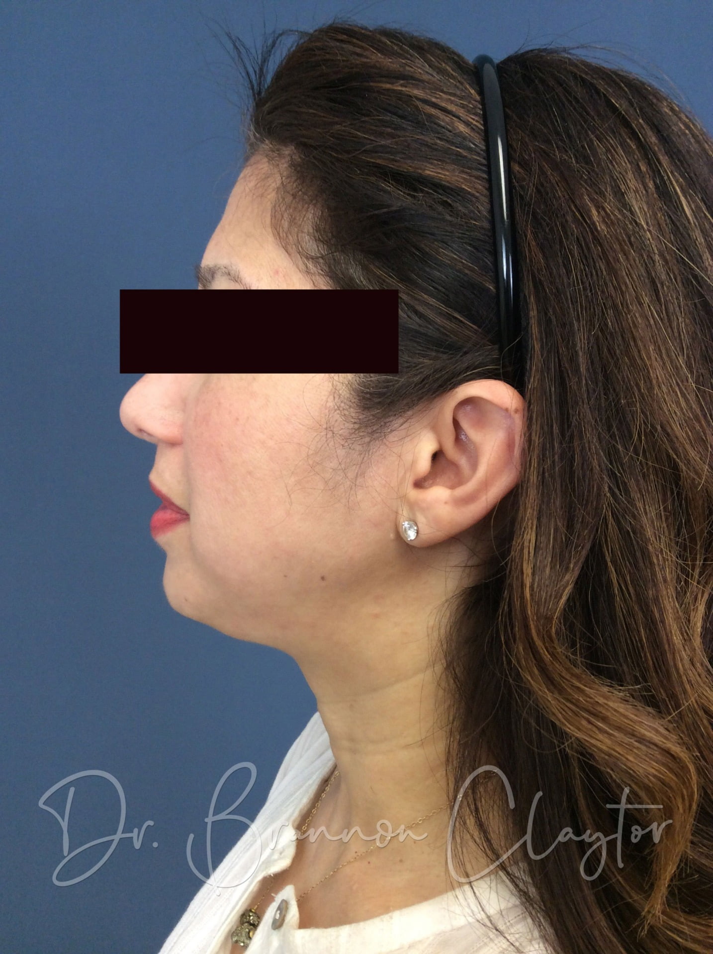 SmartLipo of the Neck