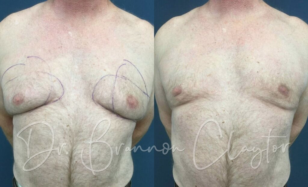 Male Breast Reduction Male Breast Reduction