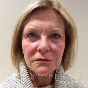 Facelift Philadelphia | Bryn Mawr PA Facelift Philadelphia | Bryn Mawr PA