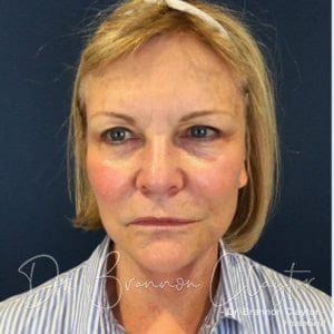 Facelift Philadelphia | Bryn Mawr PA Facelift Philadelphia | Bryn Mawr PA