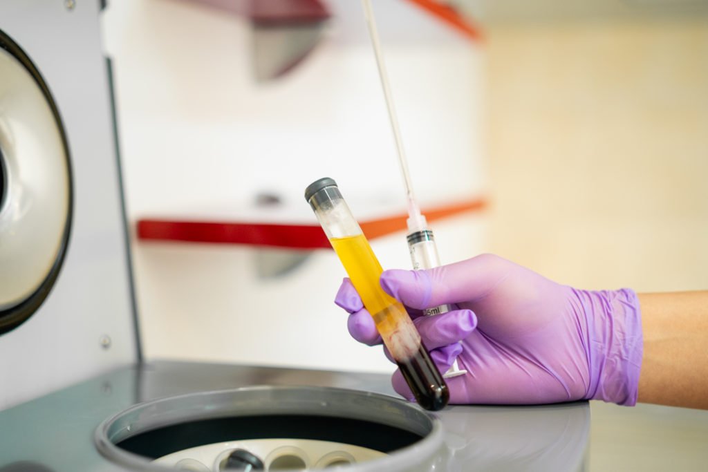 A plastic surgery nurse holds a vial to prepare it in the centrifuge for Hair Restoration, Philadelphia PA