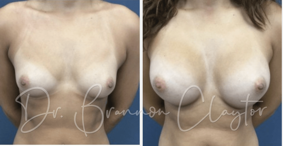 Breast Augmentation Before:After Breast Augmentation Before:After