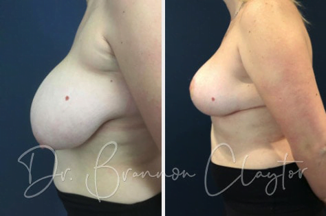 Breast Lift Before & After Breast Lift Before & After
