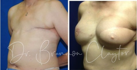 Breast Reconstruction Before:After Breast Reconstruction Before:After
