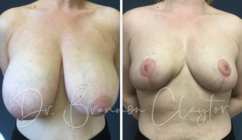Breast Reduction Before:After Breast Reduction Before:After