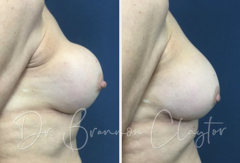 Revision Breast Augmentation Before:After Revision Breast Augmentation Before:After