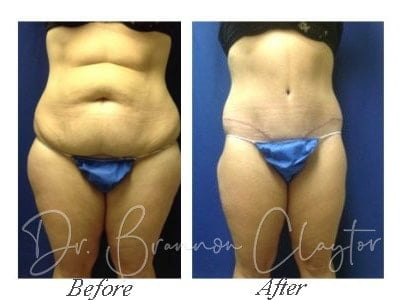 New York City Liposuction