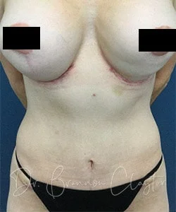 Tummy Tuck