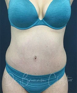 Tummy Tuck