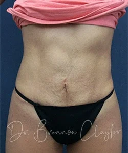 Tummy Tuck