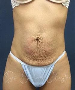 Tummy Tuck