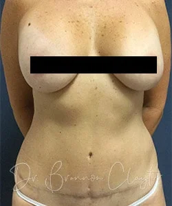 Tummy Tuck