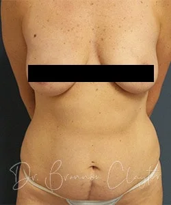 Tummy Tuck