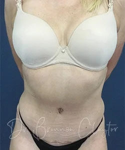 Tummy Tuck