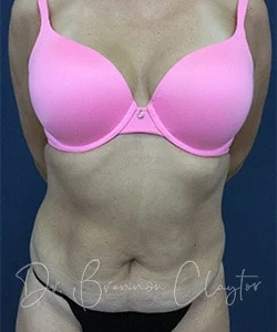 Tummy Tuck